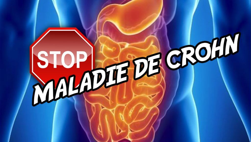 Maladie de Crohn